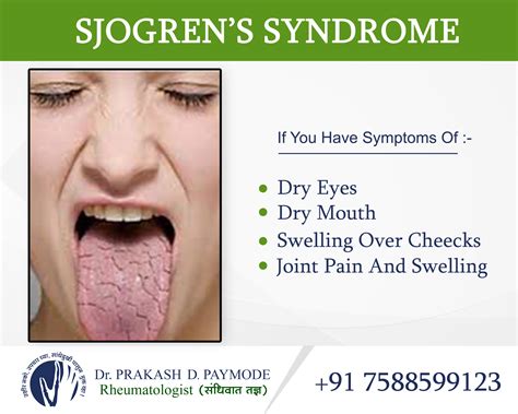 tear test for sjogren's syndrome|how do you diagnosis sjogren's.